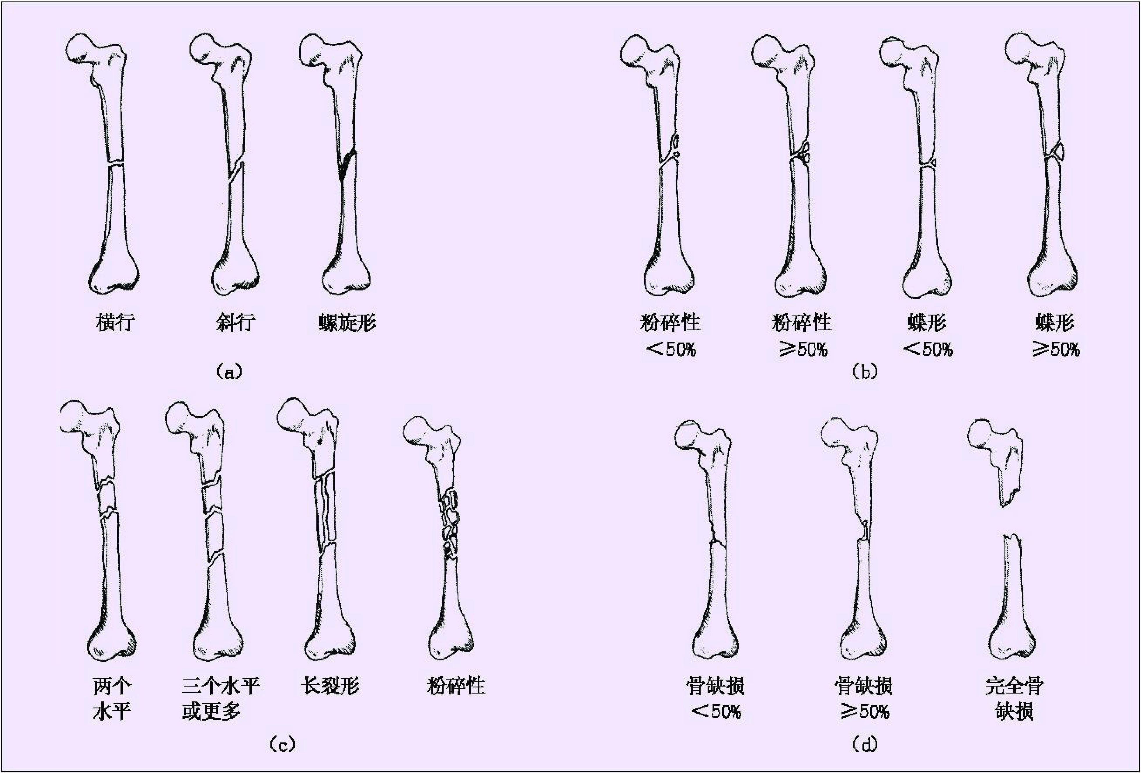 第二節(jié) 骨折分類